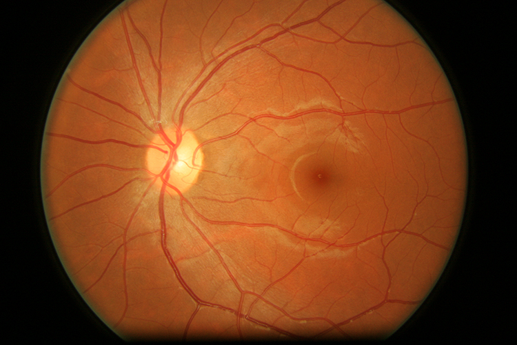 En OCT-bild på en normal ögonbotten.