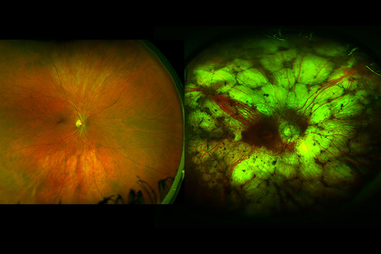 Bild på en normal ögonbotten och en ögonbotten som har en sjukdom.